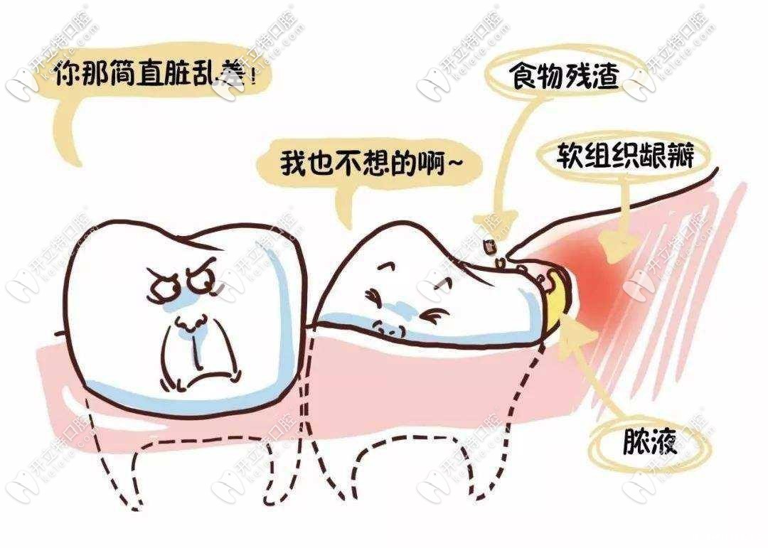 智齿塞牙 智齿塞牙