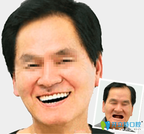 南昌德亚口腔种植牙案例