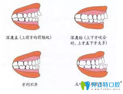 徐州博爱口腔暑期正畸优惠开始啦