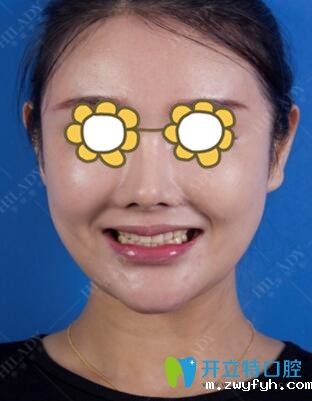 做牙贴面美白前
