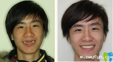 不晓得河源牙科医院哪家好,去就去拜博口腔做了种植牙修复