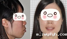 牙套毕业 分享在广州圣贝口腔拔5颗牙做正畸2年半来的体验