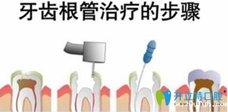 牙齿根管治疗的费用一般多少钱一颗?1500还是3000或4000元