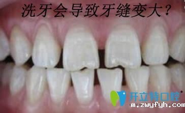 为什么医生不推荐洗牙呢,是因为洗牙会导致牙缝变大吗?