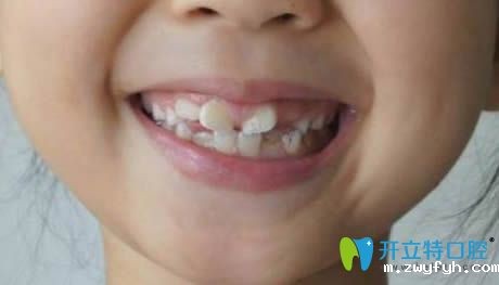 小孩新换的恒牙长歪了怎么办?恒牙长歪会自动调整归位吗?