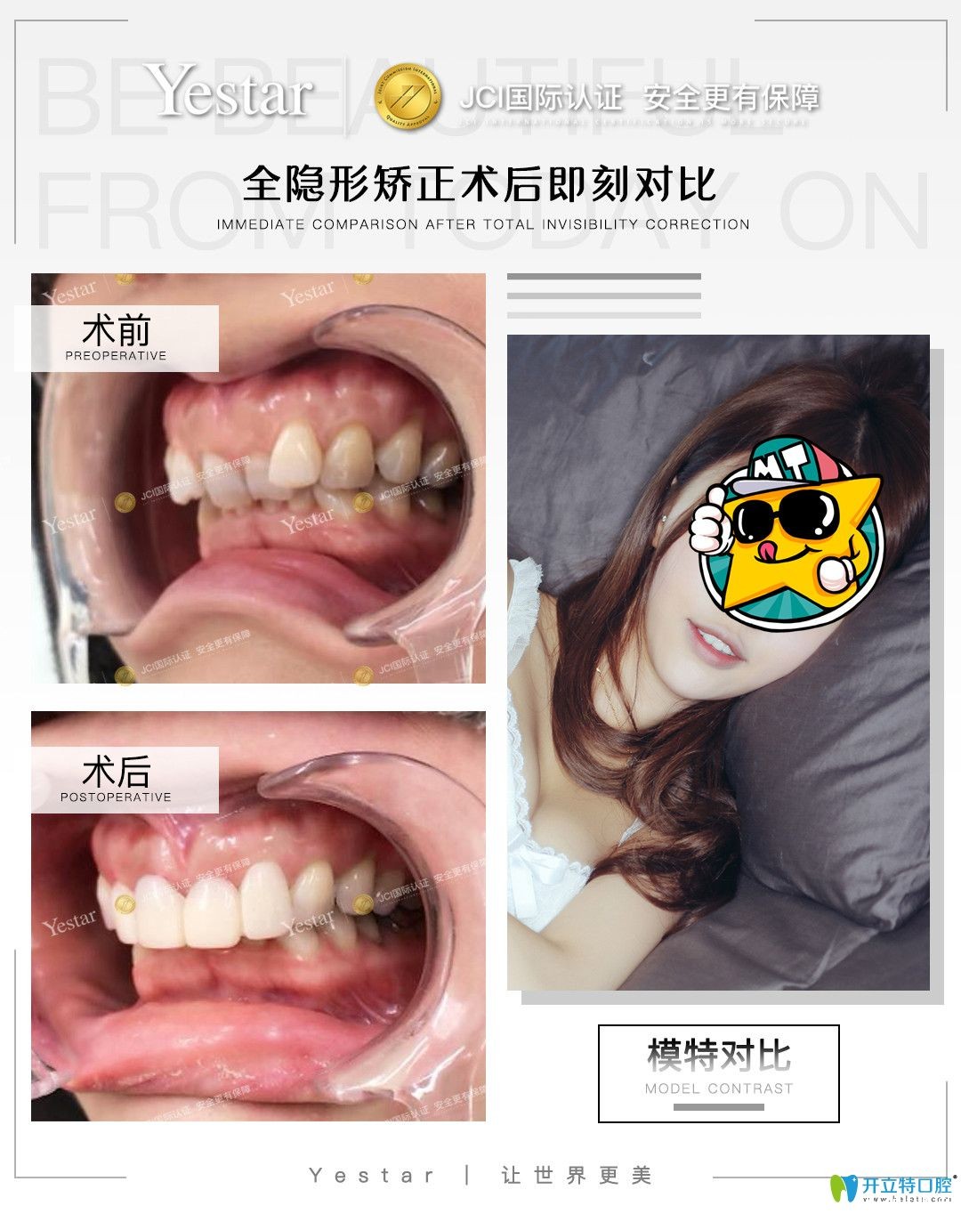 在宁波艺星口腔戴隐形牙套是什么感受，真实正畸经验分享