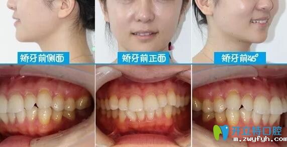 颜值逆袭!从深圳下沙韦博口腔戴隐适美牙套矫正龅牙开始