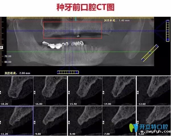 不了解珠海种牙哪家医院好，不如看看仁爱口腔即刻种植牙