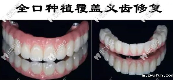 Locator种植覆盖义齿的费用和图片,送给全口无牙颌的伙计们