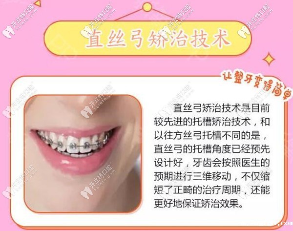 牙套党!看下我花1万多块戴直丝弓托槽矫正龅牙的效果咋样