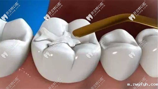补后槽牙用3M纳米树脂的z350xt还是p60好？