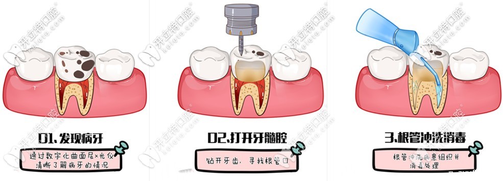 根管治疗过程