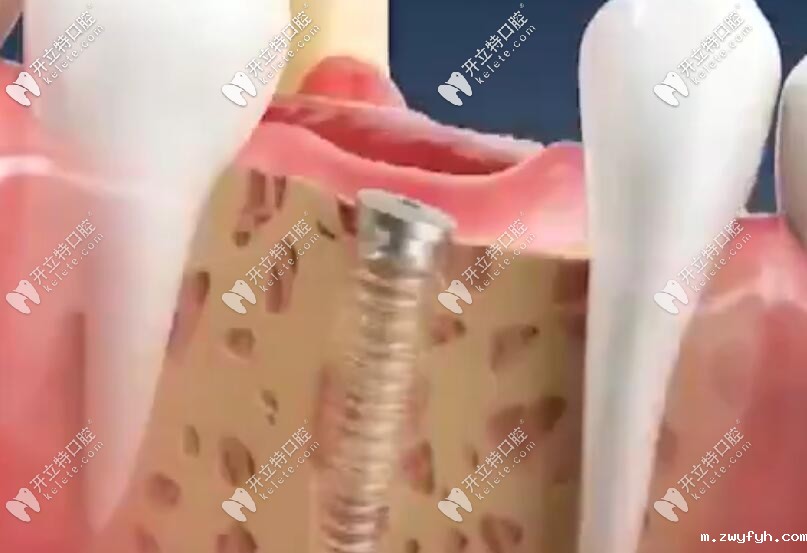 种植牙一期二期三期流程及时间详解，详细过程步骤见视频