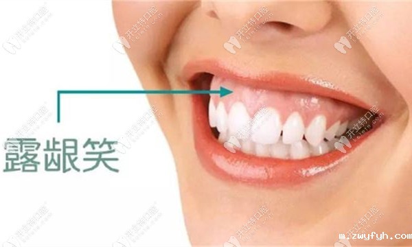 打骨钉可以有效改善露龈笑这我知道,但会不会反弹呢？