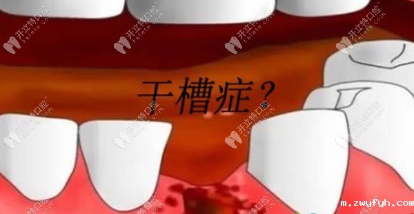 专治不明白：拔牙后血凝块掉了一定会得干槽症吗~几率多大